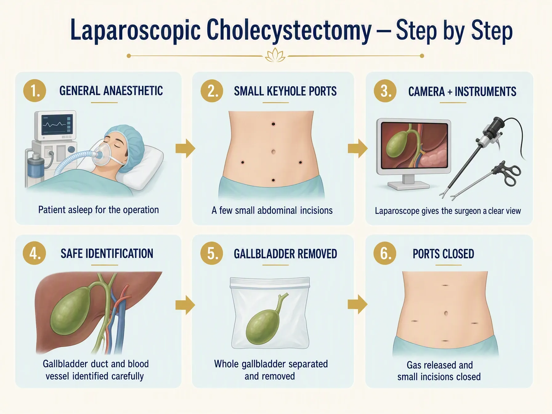 Superseded illustration: a keyhole port drawn on the patient’s left lower abdomen.